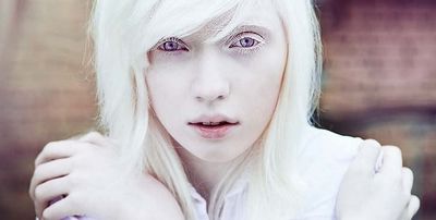 Albinism - What Causes Albinism in Humans the world have higher