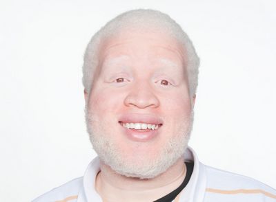 Albinism - What Causes Albinism in Humans brown in color