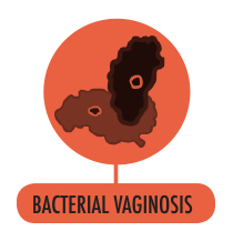 Bacterial Vaginosis - Understanding the Facts to stay away from
