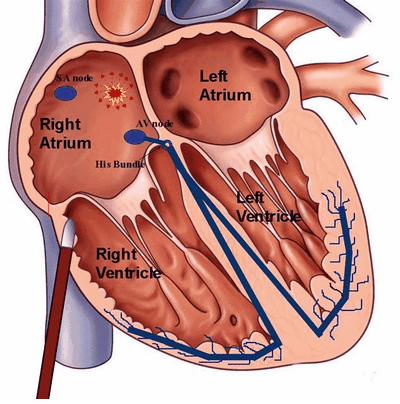 Cardiac Ablation Therapy - A Brief Overview Although cardiac ablation is