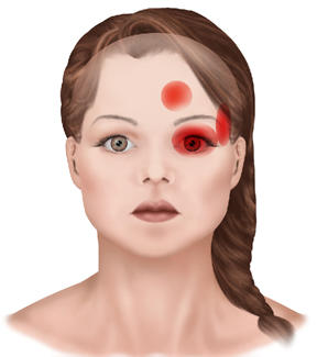 Headache Behind Eyes - How to Deal With This Painful Headache migraine headache