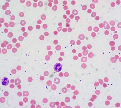 Hemolytic Anemia and Doppler Ultrasonography Because hemoglobin is the substance
