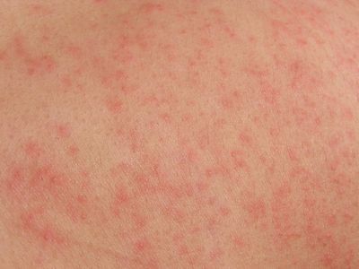 Skin Allergies And The Effects Of Rash allergies, dust mites