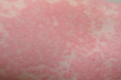 Skin Allergies And The Effects Of Rash if there are any allergens