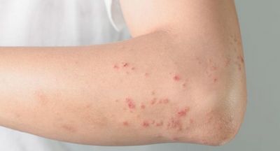 Skin Allergies And The Effects Of Rash that feed off of dead