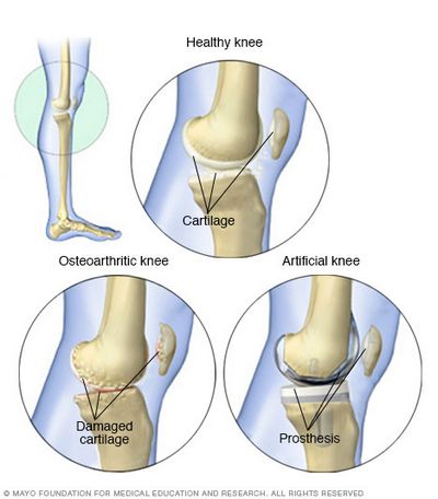 What to Do About Knee or Ankle Problems to help determine what type